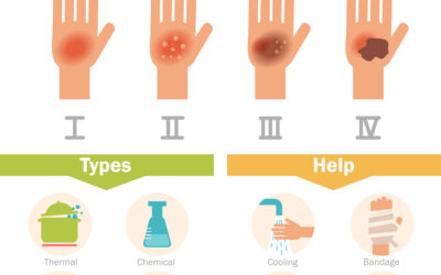 Workplace Burn Awareness