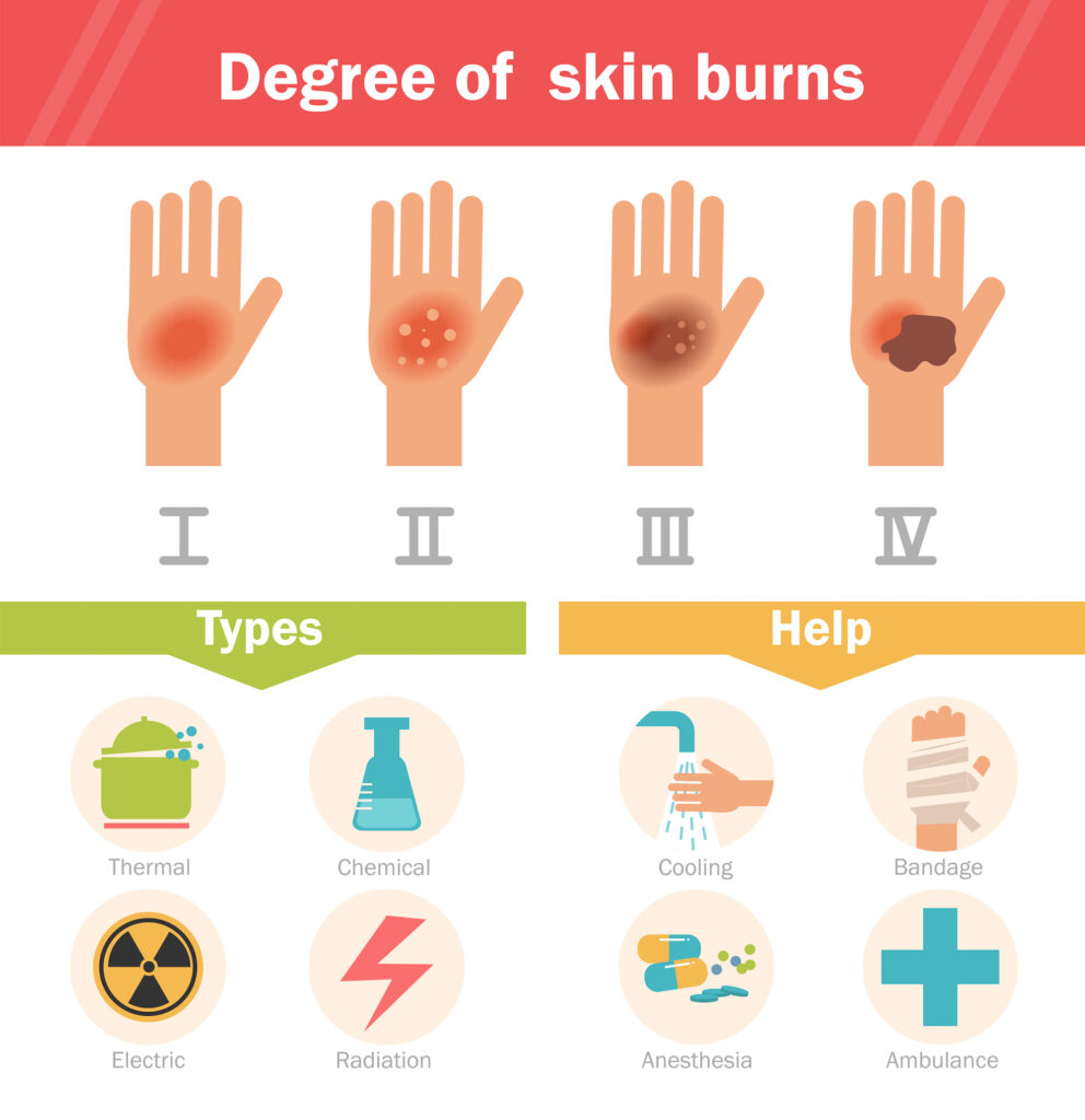 Workplace Burn Awareness